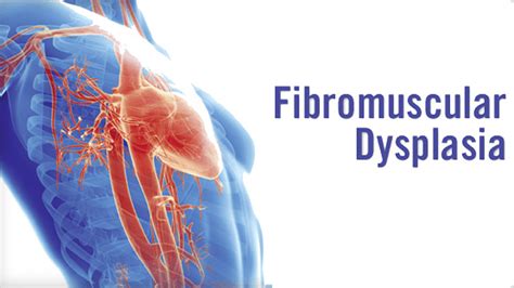 Fibromuscular Dysplasia: Causes, Symptoms, Diagnosis and Treatment