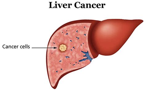 Cancer de ficat - tratament - e-medicina.md