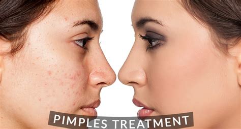 Best Pimple Treatment in Hyderabad | Dr Venus Skin Clinic