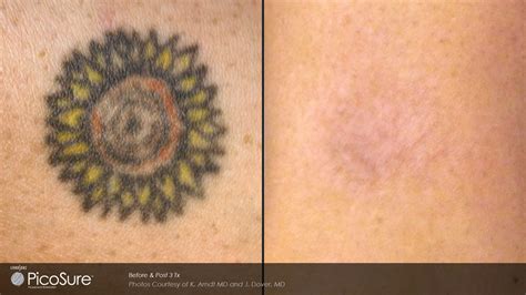 Introducing Laser Tattoo Removal! | Dr Monica Scheel Dermatology, Kailua-Kona, HI