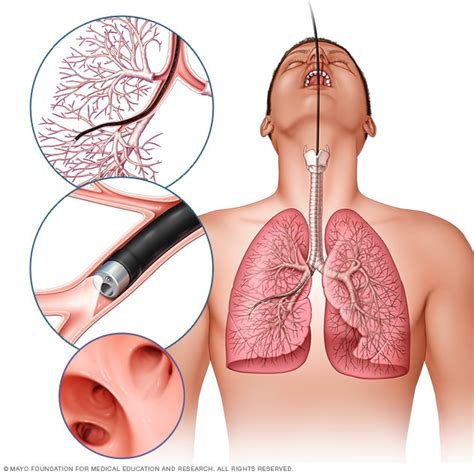 Bronchoscopy – Intelligent Haptronic Solutions Inc.