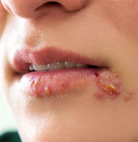 calina acampar conformidad herpes labial productos Cementerio Prima esponja