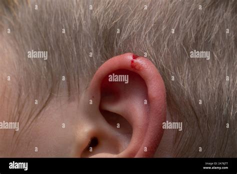 Laceration ear injury hi-res stock photography and images - Alamy
