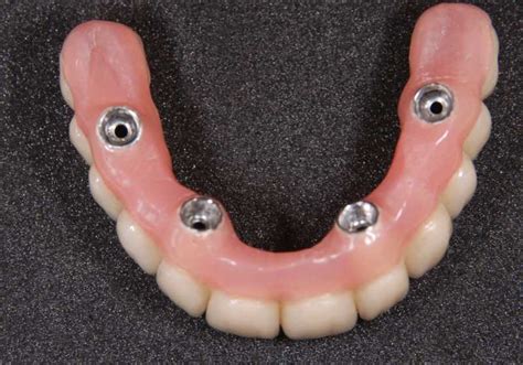Full Arch Implant Bridges | Demajo Dental