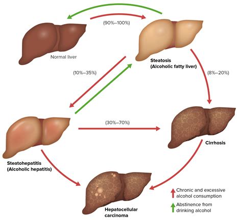 Alcoholic Liver Disease | Concise Medical Knowledge