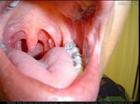 The elevated round pink area on the left tonsil appears to be approximately 4 mm in diameter. My ...