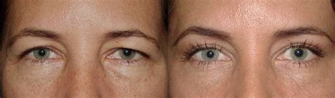 Brow lift with upper and lower blepharoplasty - Dr. Guy Massry