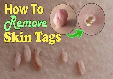 11 Best Essential Oils For Skin Tags Removal + How To Use