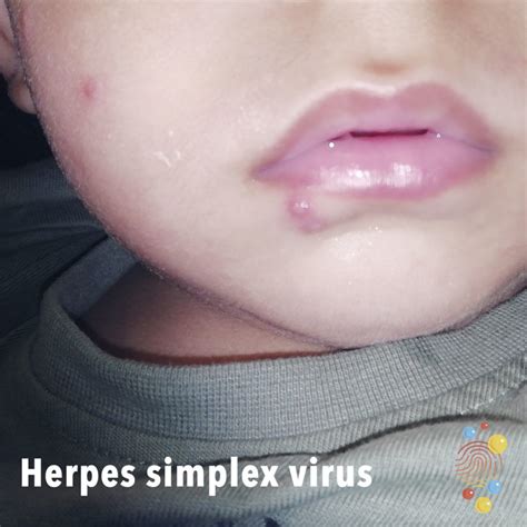 Herpes simplex virus - Skin Deep