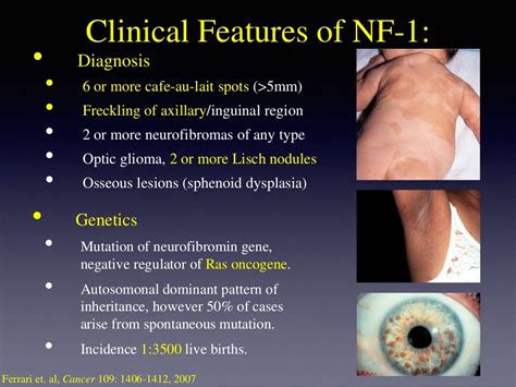 Peripheral Nerve Sheath Tumors