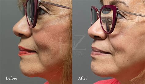 Upper Lip Lift Before & After — HZ Plastic Surgery