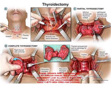 Goiter Removal