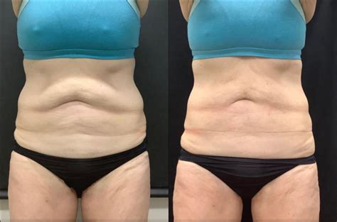 Accufit Before & After Photos Patient 30 | Washington, DC | MI Skin ...