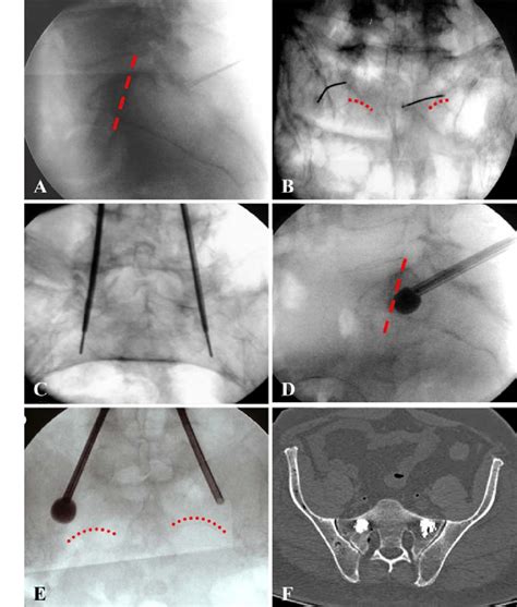 Sacroplasty using fluoroscopic guidance. Lateral view, marking of the... | Download Scientific ...