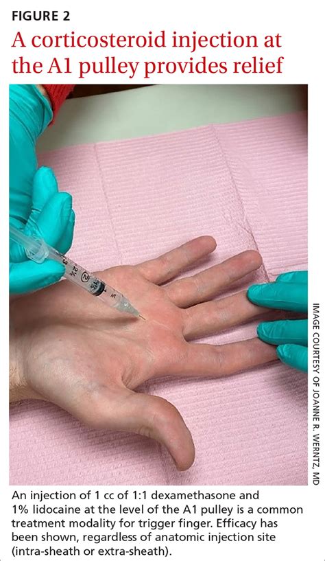 Recognizing and treating trigger finger | MDedge Family Medicine