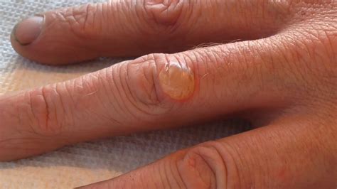 Burn Blister #2 By Jane Shemilt/science Photo Library