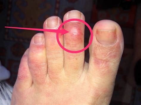 'COVID Toes': the Latest Unusual Symptom in Coronavirus Patients - Business Insider