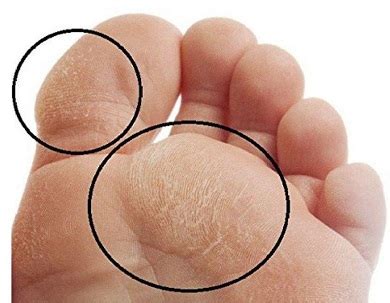 Foot Corns & Calluses: Causes & Treatment - Foot Pain Explored