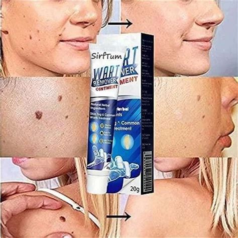 Warts Off Instant Blemish Removal Cream 20 G Wart Remover Ointment For ...