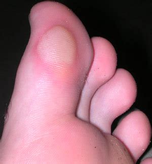 Foot Blister Care | MedGuidance