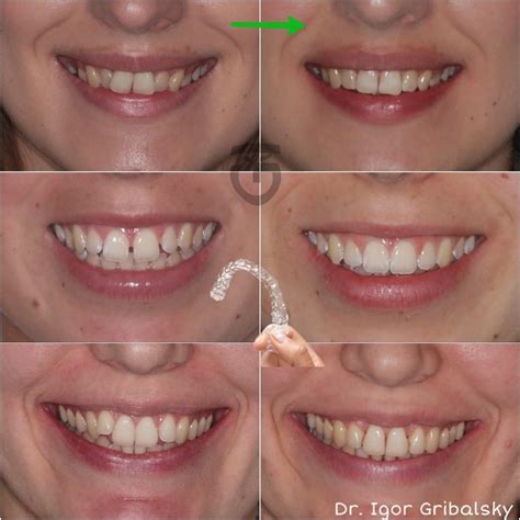 Clear aligners. Straight teeth without braces. Orthodontist Specialist ...