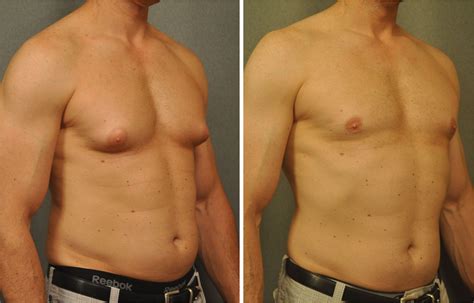 Pin on Changes: Male Cosmetic Procedures