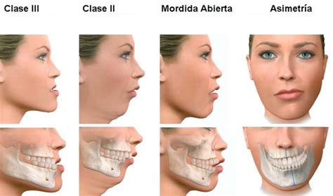 Si duele la mandíbula al morder quizás tengas maloclusión dental