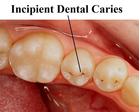What is incipient caries? | News | Dentagama