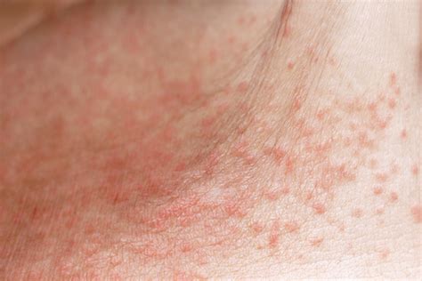 Heat Rash Causes Symptoms Treatments Heat Rash Heat Rash Causes - Riset