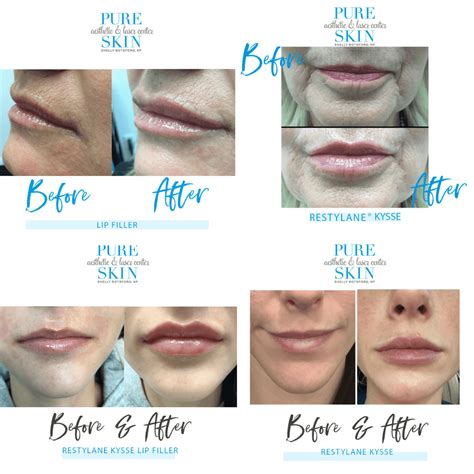 Restylane On Lips Before And After | Lipstutorial.org