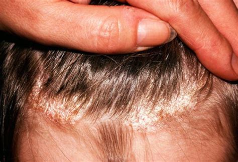 Causes of Dry Patches on Scalp and Treatments - Skincarederm