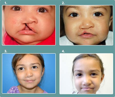 Cleft Palate Repair Before And After