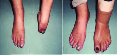 Silicone partial foot prosthesis. | Download Scientific Diagram