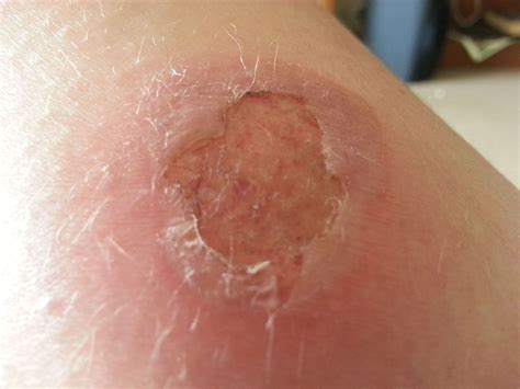2nd-Degree Burns: Healing Stages, Pictures, Causes, Treatment