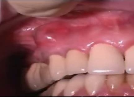 how to drain a tooth abscess - Crista Cowles