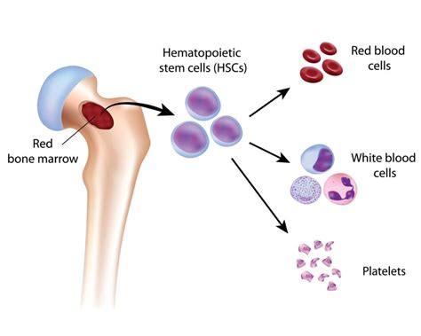 Myelodysplastic Syndrome - Symptoms, Causes, Types, Top 4 Ultimate Risk ...