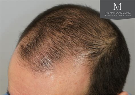 Hair Thinning Treatments - Causes and Solutions