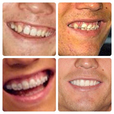 Cristiano Ronaldo Teeth