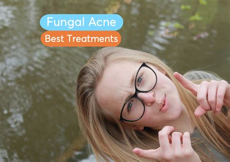 Fungal Acne Causes And Treatments | MDacne