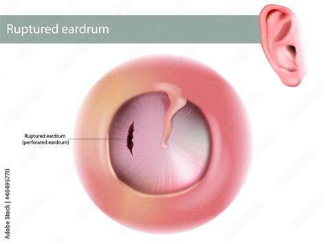 Ruptured eardrum or perforated eardrum. Tympanic membrane perforation. Hole in the eardrum ...