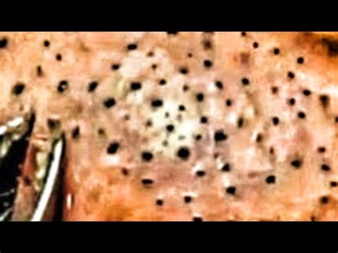 Texas' Largest Blackheads, Blackhead Fields, Big Cysts, Spreading Blackheads! - YouTube