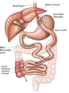 5 Facts of Roux En Y Gastric Bypass Complications