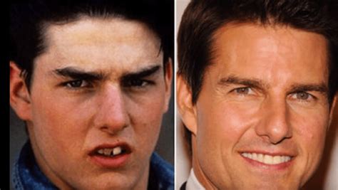 Tom Cruise Teeth Before And After : Celebrity teeth: before and after ...