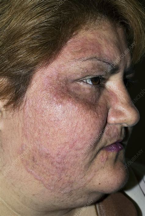 Tinea fungal infection on the face - Stock Image - C010/3370 - Science Photo Library