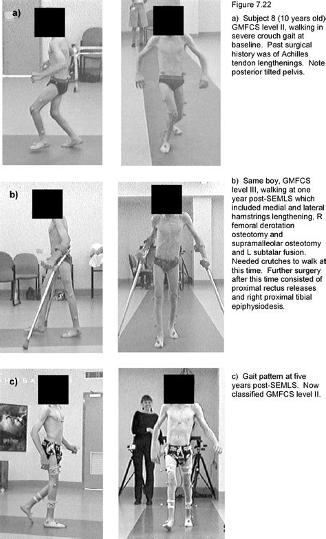 Severe crouch gait in the sagittal gait patterns of spastic diplegic ...