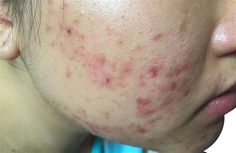 Cystic Acne: Symptoms, Causes, Pictures & Treatment