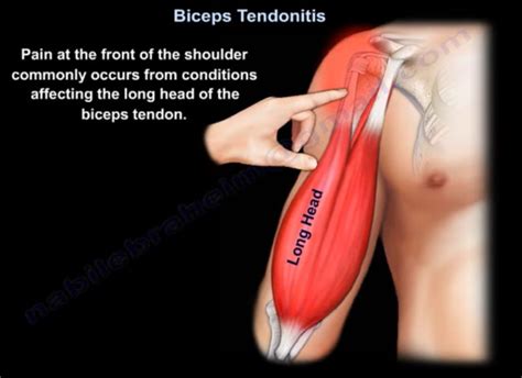 Biceps Tendonitis — OrthopaedicPrinciples.com