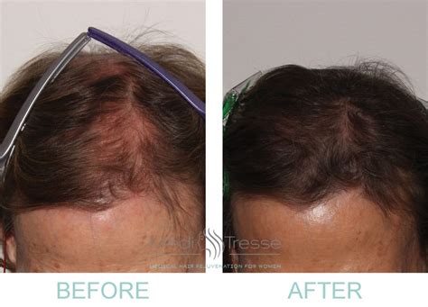 Pin On Lllt Low Level Laser Therapy For Hair Loss