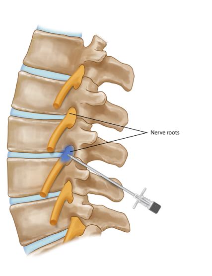 Nerve root block - Stavya Spine