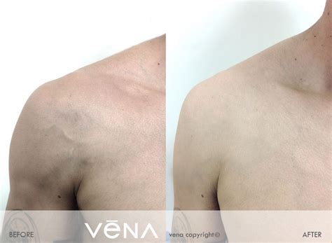 Vena | chest veins